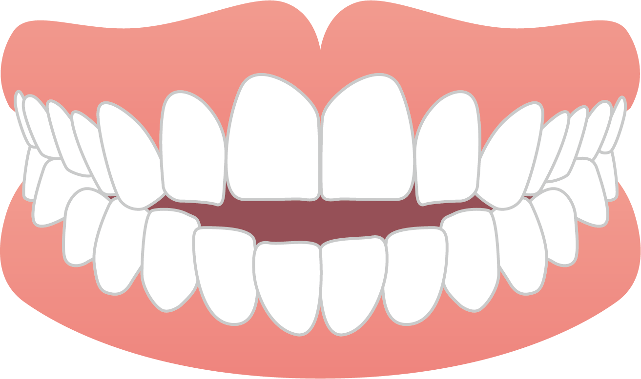 「ひまわり歯科」前歯で噛めない（開咬）