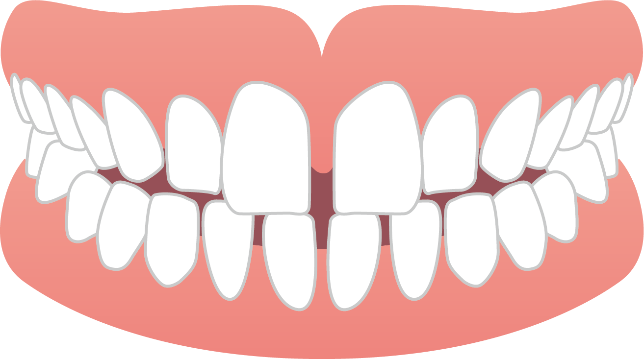 「ひまわり歯科」すきっ歯