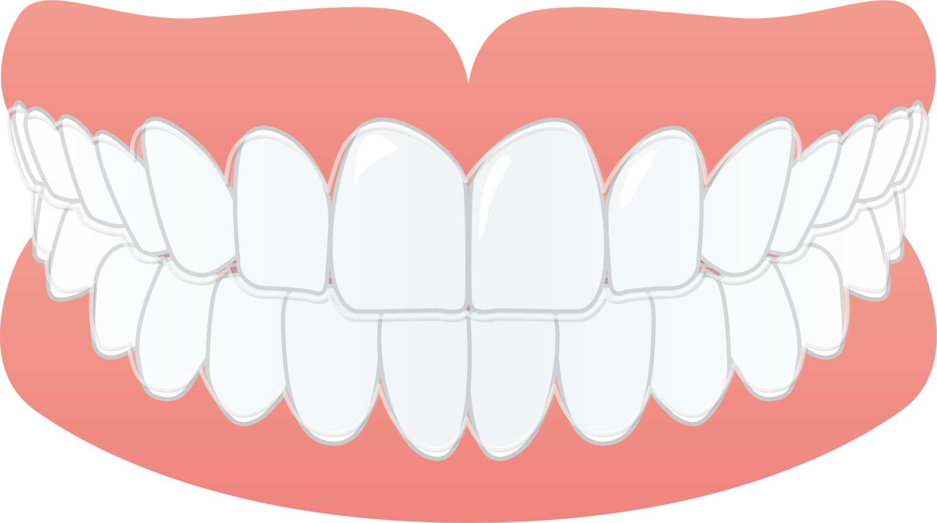 「ひまわり歯科」マウスピース型矯正装置（インビザライン）